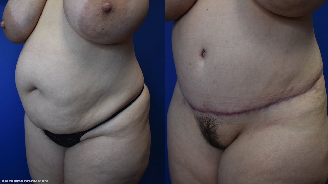 Milf's Dramatic Tummy Tuck Transformation Revealed